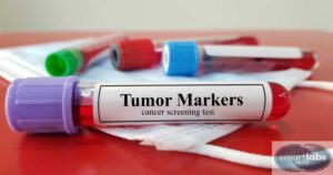 A CBC blood sample labelled for tumor-marker detection. Which CBC Blood Tests May Indicate Cancer?