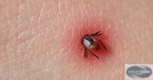 A Lyme Disease tick infestation