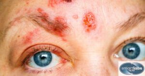 Facial sores characteristic of severe Herpes infection