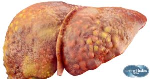 A visibly diseased liver