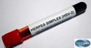 HSV-2 Blood Sample Vial