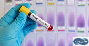 Herpes Test Blood Sample