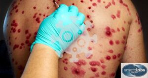 A male patient with 'angry' Herpes sores