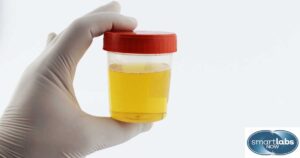 A urine sample taken for STI screening