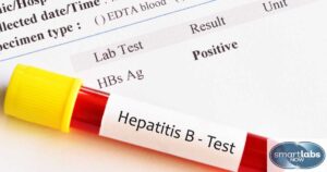 A Hepatitis B patient blood sample