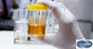 A urine sample for Gonorrhea confirmation.