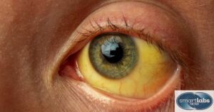 A clearly jaundiced eye (symptom of Hepatitis B infection)