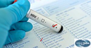 Some good-to-knows about HSV testing