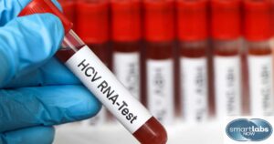 An HCV RNA Test Patient Blood Sample