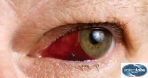 A subconjunctival hemorrhage.